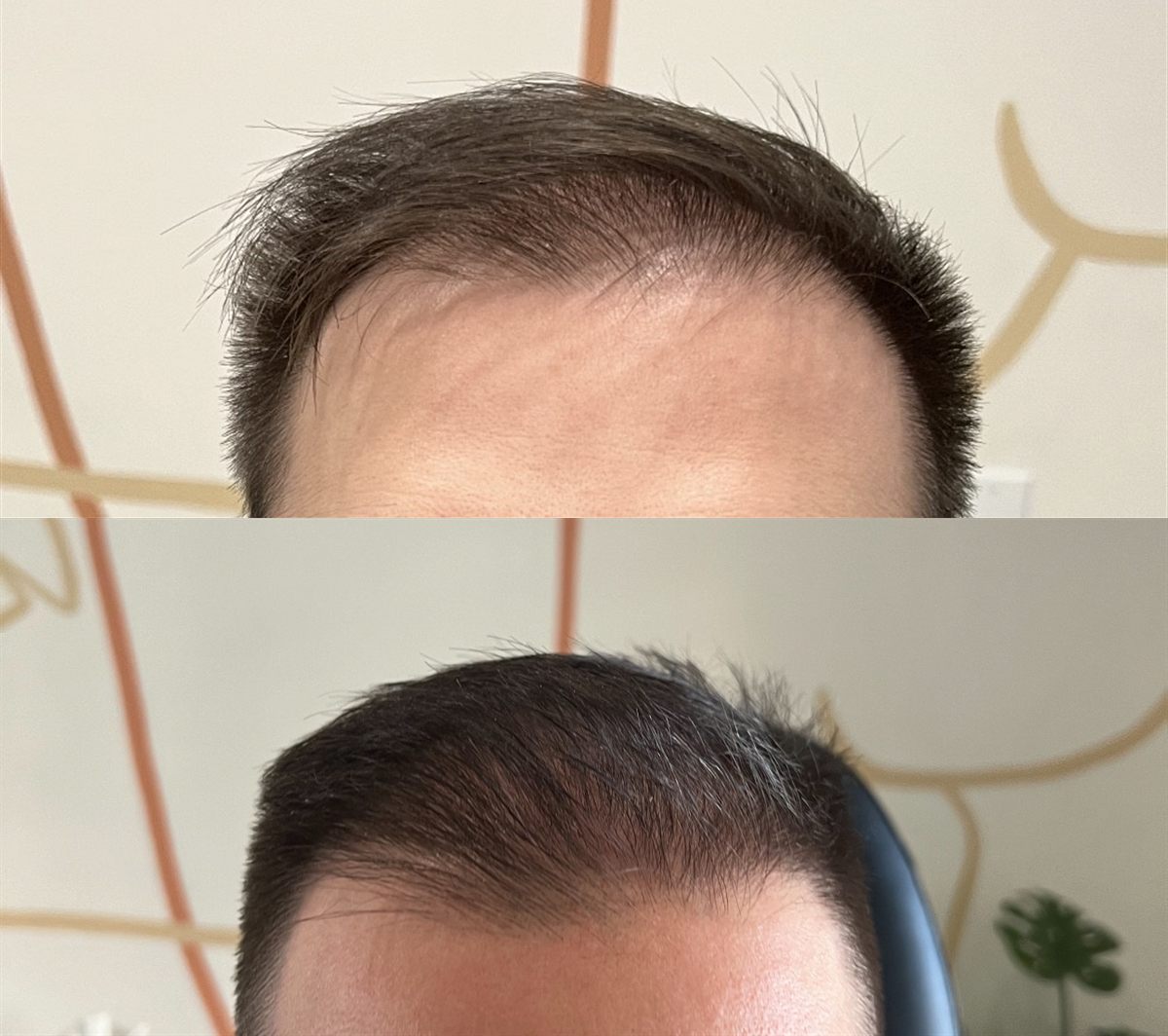 Mike's hairline before treatment and fuller along the front after three sessions