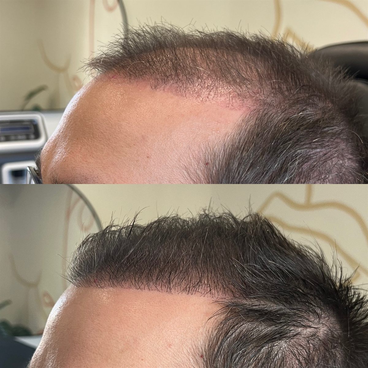 Nathan's hairline shortly after his hair transplant, and grown in two sessions later