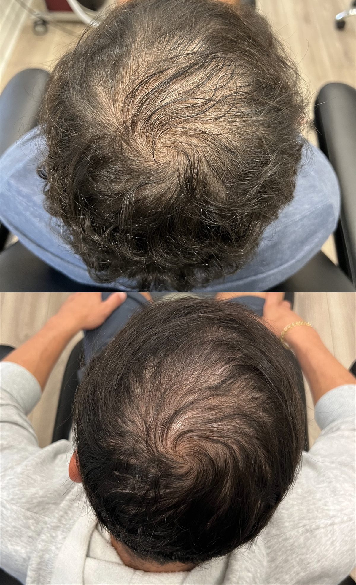 Top-down views of Nico's crown: thinning before treatment, denser coverage after three sessions